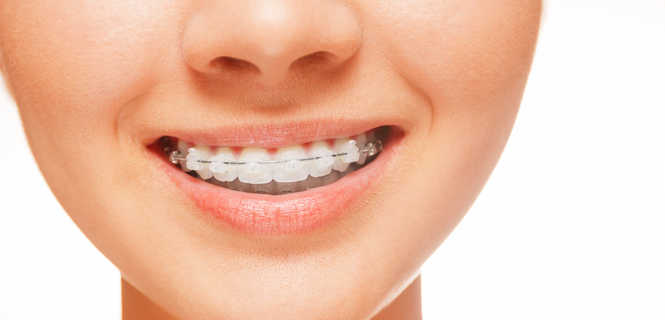Aparaty ortodontyczne stałe a ruchome