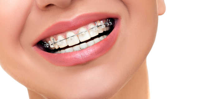 Czy założenie aparatu ortodontycznego boli?