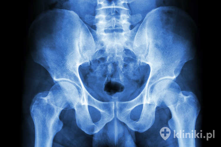 Endoprotezoplastyka stawu biodrowego jest skuteczną metodą leczenia zaawansowanych zmian zwyrodnieniowych