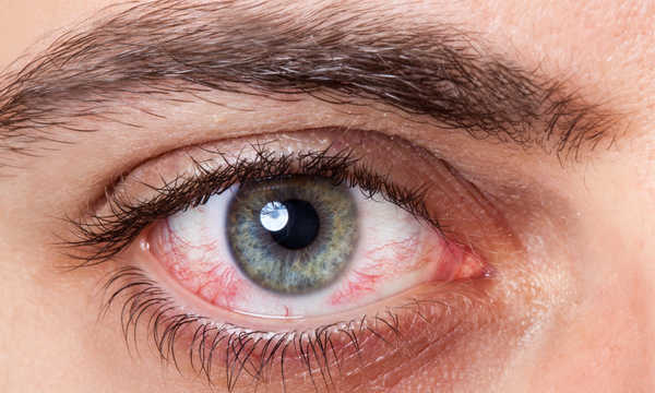 Kanaloplastyka polega na poszerzeniu kanału Schlemma i usprawnieniu drenażu bez wytwarzania przetoki