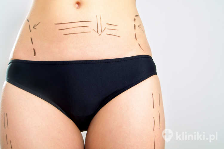Kobieta przed zabiegiem liposukcji LAL, obrysowane miejsca odsysania tłuszczu