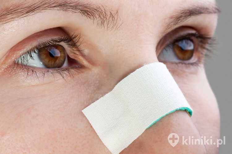 Plaster na nosie kobiety po operacji metodą otwartą