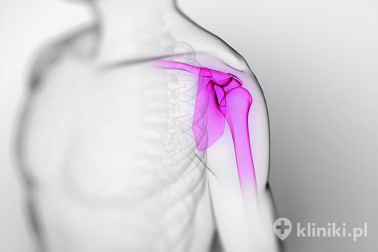 Wskazania do endoprotezy stawu barkowego