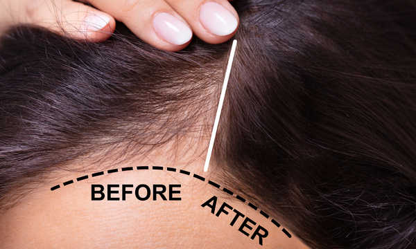 Zabiegi zagęszczania włosów dobierane są indywidualnie w zależności od stopnia utraty włosów i oczekiwań pacjenta