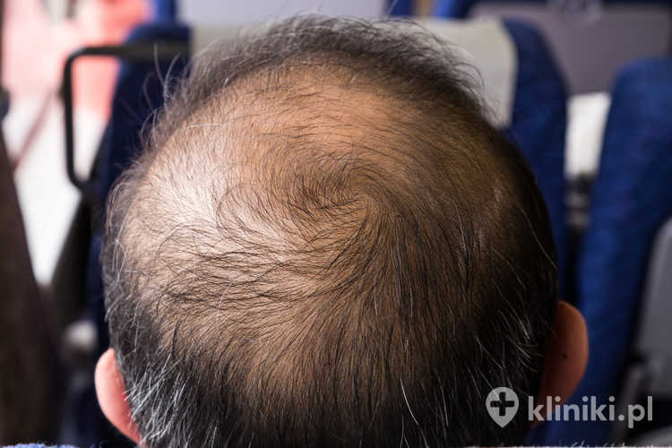 Zagęszczanie włosów u mężczyzn to skuteczny sposób na poprawę gęstości fryzury i ukrycie przerzedzeń