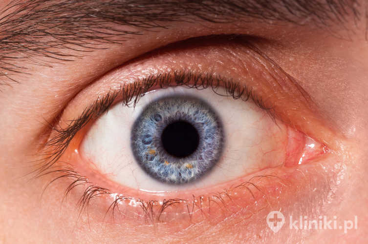 Cyklofotokoagulacja w leczeniu jaskry może zmniejszyć dolegliwości bólowe i poprawić komfort życia pacjenta