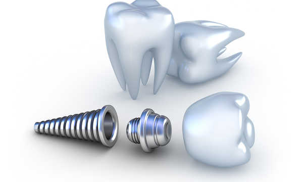Czy implant zębowy może się nie przyjąć?
