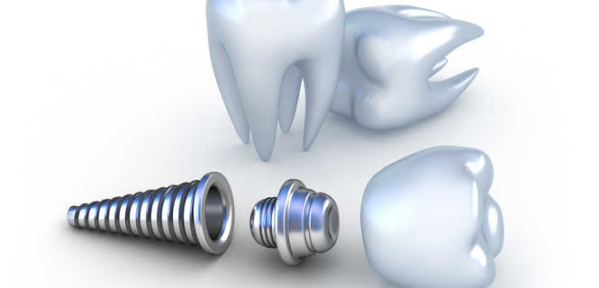 Czy implant zębowy może się nie przyjąć?