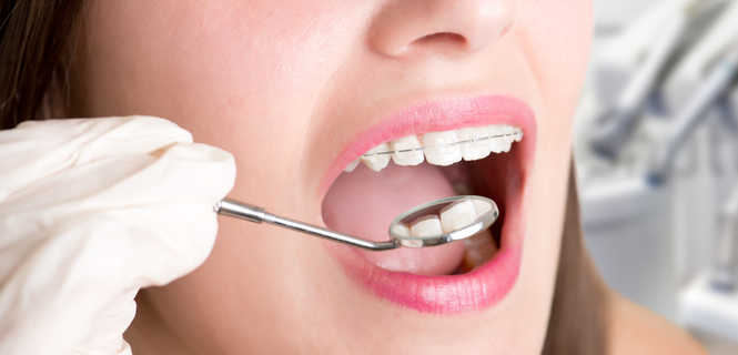 Jak długo trwa założenie aparatu ortodontycznego?