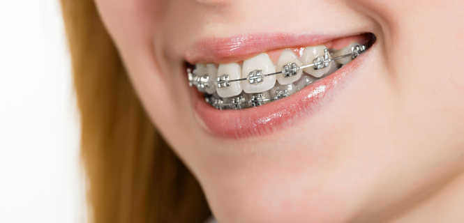 Jakie są zalety leczenia ortodontycznego z zastosowaniem aparatów samoligaturujących?