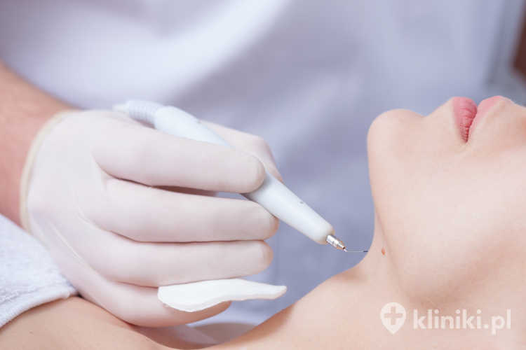 Brodawki często usuwane są za pomocą lasera