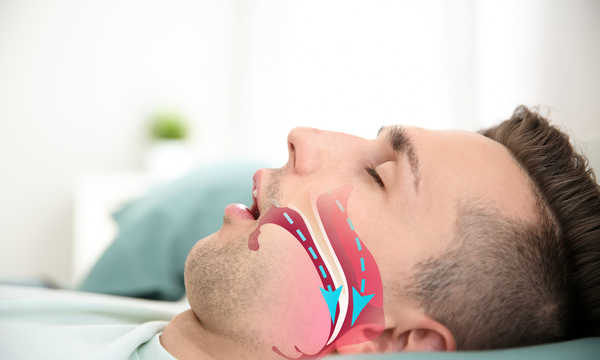 Leczenie chrapania techniką koblacji redukuje drgania podniebienia, które są jedną z głównych przyczyn chrapania