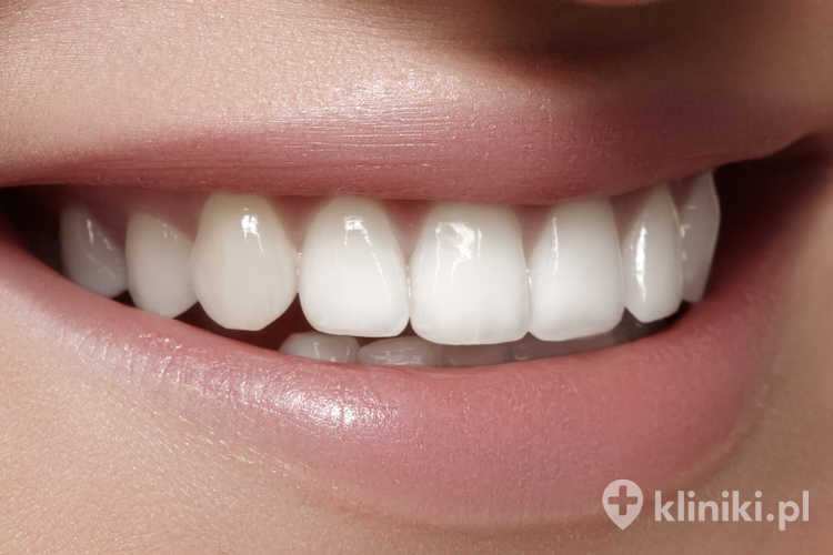 Licówki porcelanowe w systemie CEREC