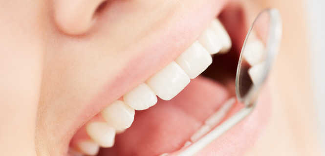Nakładkowe wybielanie zębów - w domu lub w gabinecie