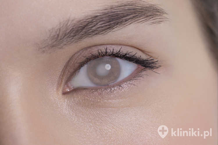 Zaćma polega na zmętnieniu soczewki oka