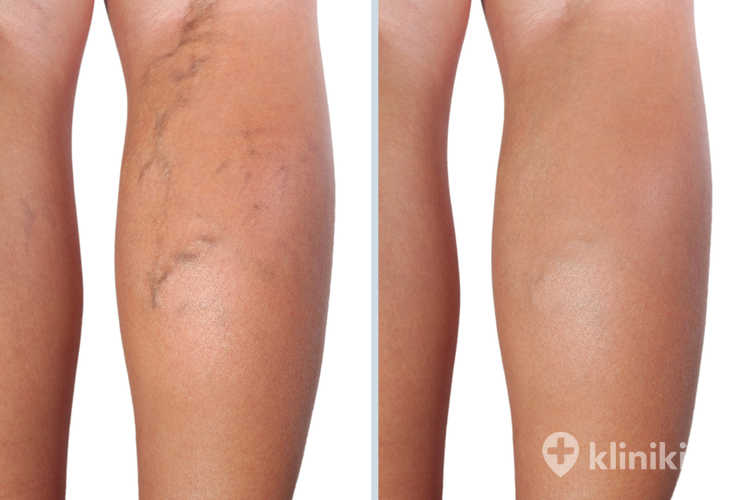 Zdjęcia przed i po zabiegu skleroterapii