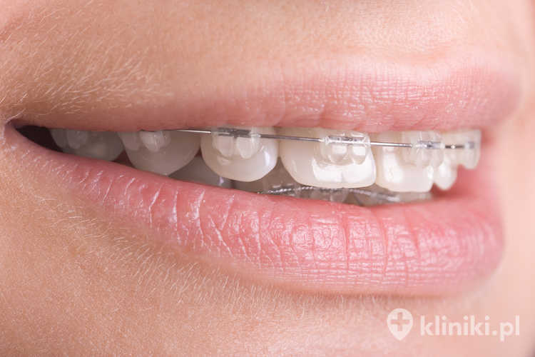 Aparat ortodontyczny