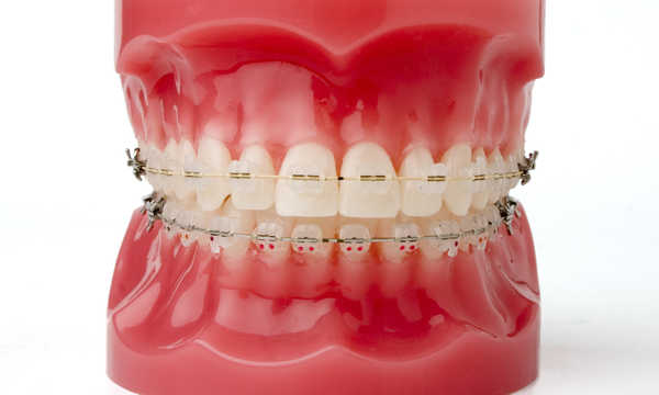 Leczenie ortodontyczne - czy można przeprowadzić je w ramach NFZ?