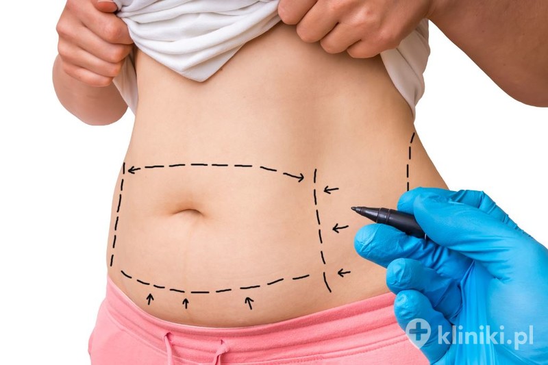 Czy efekty plastyki brzucha są stałe? | Kliniki.pl