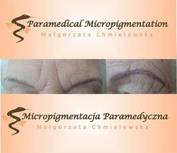 Korekta makijażu permanentnego - pigmentacja medyczna przed i po zabiegu