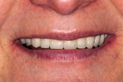 Przypadek 1. Wykonano korony porcelanowe na wszystkich przednich zębach oraz protezę szkieletową odbudowującą brakujące zęby w odcinku bocznym. Zastosowano tzw. zatrzaski boczne, które pozwoliły na eliminację nieestetycznych metalowych klamer.