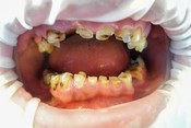 Przypadek 2. Pacjent z dentofobią , od lat nieuczęszczający do lekarza stomatologa. Problem stanowiły liczne braki zębowe, bardzo duże zniszczenie próchnicowe pozostałych zębów. Pacjent bardzo zmotywowany do leczenia i zmiany nawyku dbania o zdrowie zębów.