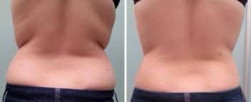 Liposukcja laserowa - brzuch i talia przed i po zabiegu