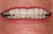 Przypadek 3. Wykonano korony porcelanowe na na górnych zębach. Dolne zęby poddano wybielaniu.