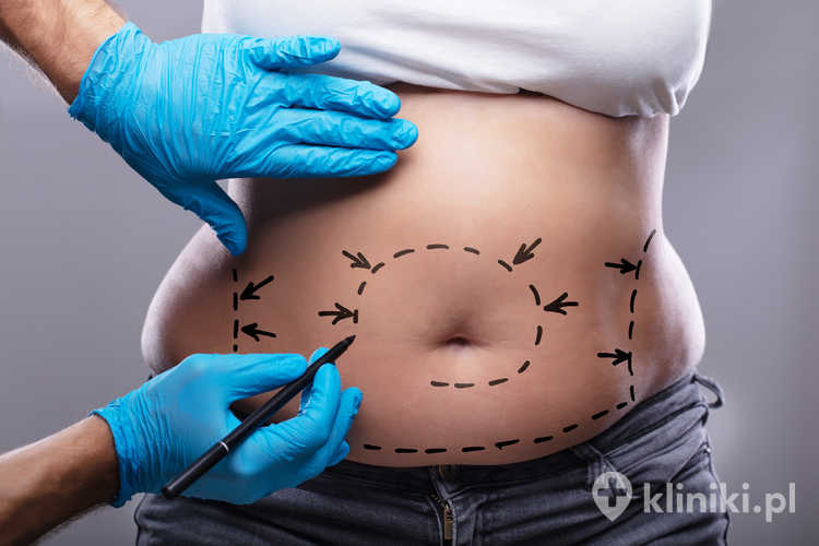 Liposukcja to rozwiązanie dla osób z miejscowym nagromadzeniem tkanki tłuszczowej