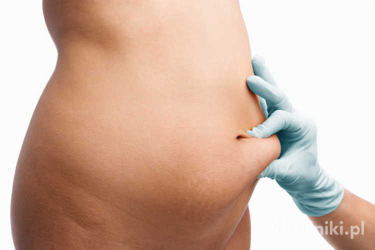 Dzięki liposukcji można skutecznie pozbyć się depozytów tłuszczowych z brzucha
