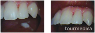 Stomatologia zachowawcza przed i po zabiegu