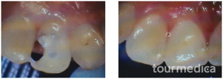 Stomatologia zachowawcza przed i po zabiegu