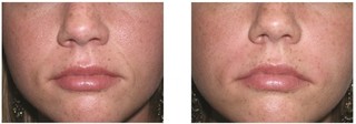 Bruzdy nosowo-wargowe - usuwanie zmarszczek kwasem hialuronowym przed i po zabiegu
