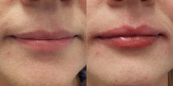 Modelowanie ust wypełniaczem przed i po zabiegu