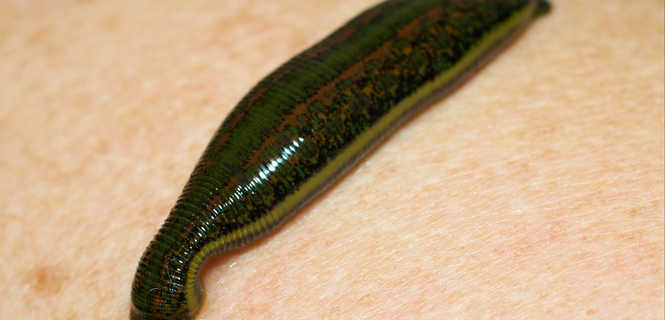 Leczenie żylaków pijawkami