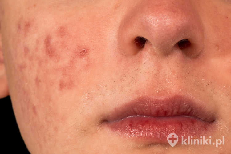 Przygotowanie pacjentki do zabiegu przy pomocy lasera CO2