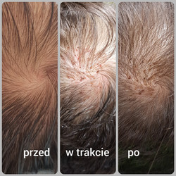 Implantacja włosów BIOFIBRE przed i po zabiegu