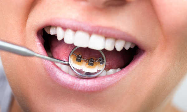 Rodzaje aparatów ortodontycznych - porównanie