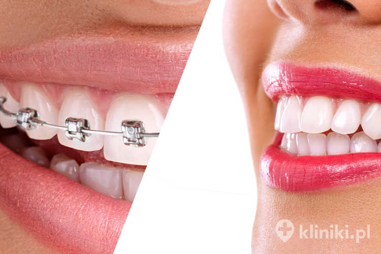 Rodzaje aparatów ortodontycznych stałych mogą być metalowe, tytanowe, estetyczne, lingwalne lub samoligaturujące