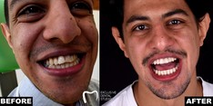 Ortodoncja przed i po zabiegu