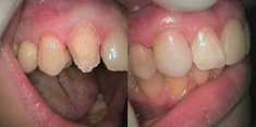 Protetyka stomatologiczna przed i po zabiegu