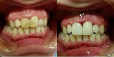 Stomatologia zachowawcza przed i po zabiegu