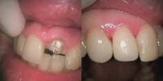Stomatologia zachowawcza przed i po zabiegu