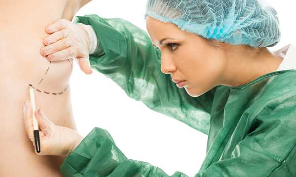 Lekarz chirurg rysuje na piesi kobiety linie cięcia do wszczepienia implantu piersiowego
