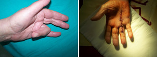 Operacje i leczenie ręki / łokcia / nadgarstka przed i po zabiegu
