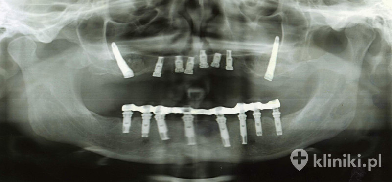 Zdjęcie RTG z widocznymi implantami zygomatycznymi