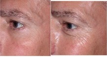 Pacjent przed i po zabiegu plazmą i pełnej regeneracji skóry wokół oczu (około 2 miesięcy). Efekt osiągnięty już po jednym zabiegu Plexr
