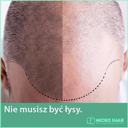 Zabiegi mikropigmentacji włosów przed i po zabiegu